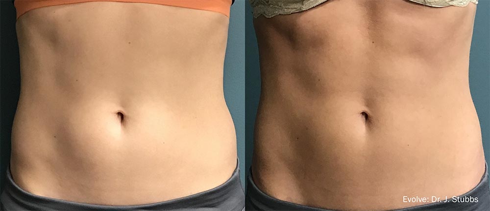 Before and After Photo for Toning Abs using EvolveX