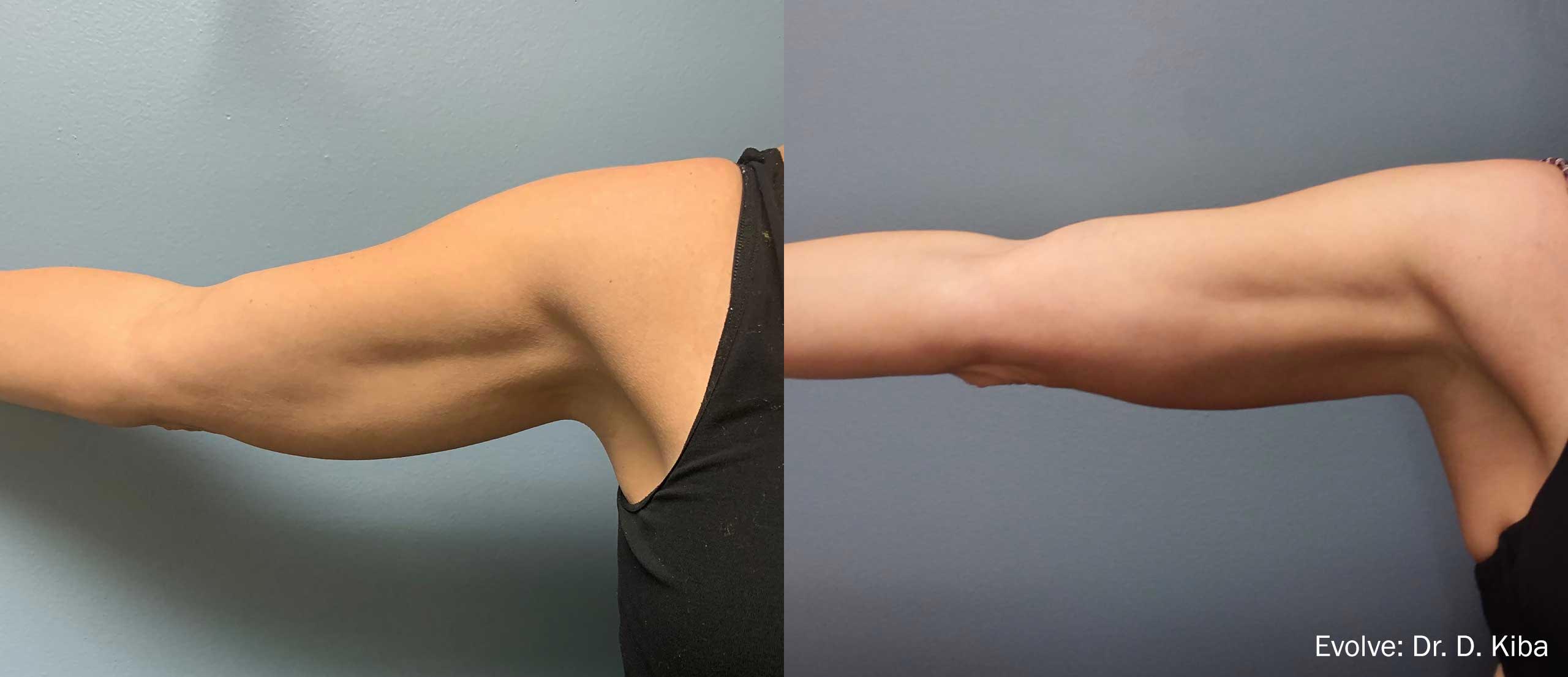 Tite Effect on Arms - Before and After