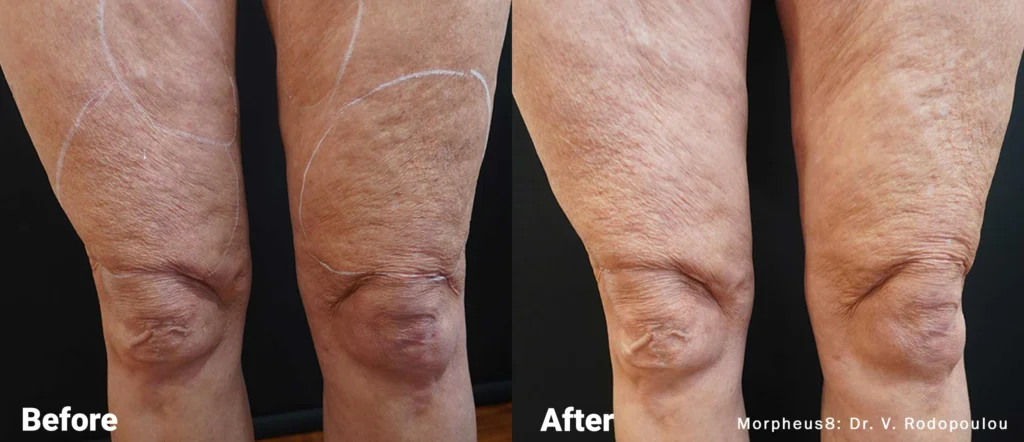 Morpheus8 in Fort Myers before and after of a woman's thighs