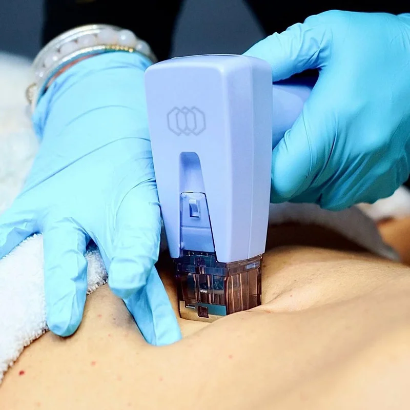 Morpheus8 on the Stomach