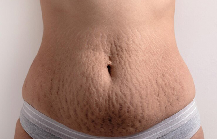 You are currently viewing Stretch Marks: Causes, Prevention, and Treatment