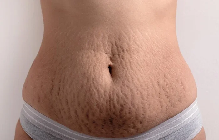 Woman Visible Stretch Marks