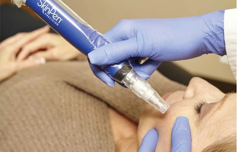 microneedling