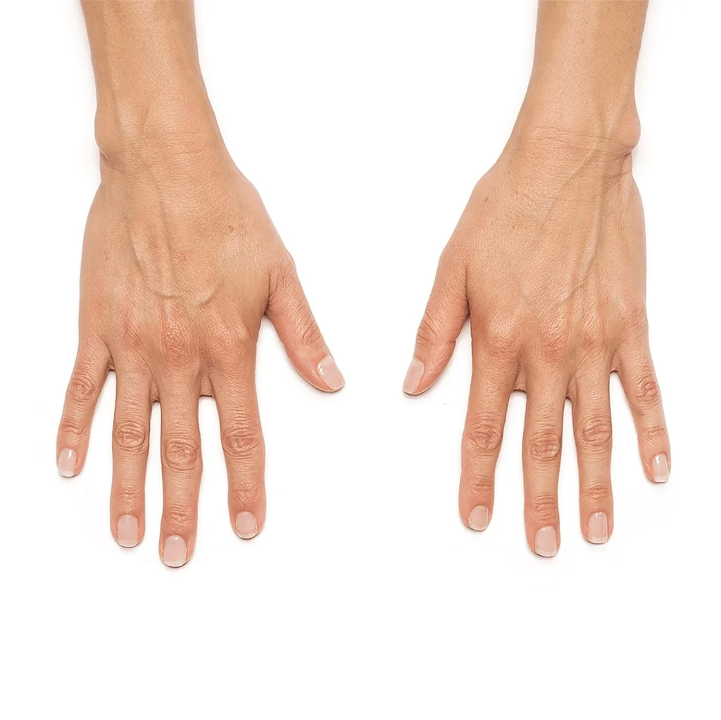 Hand Rejuvenation Before