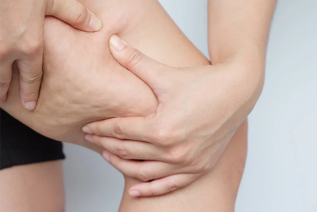 Effective Strategies to Reduce Cellulite