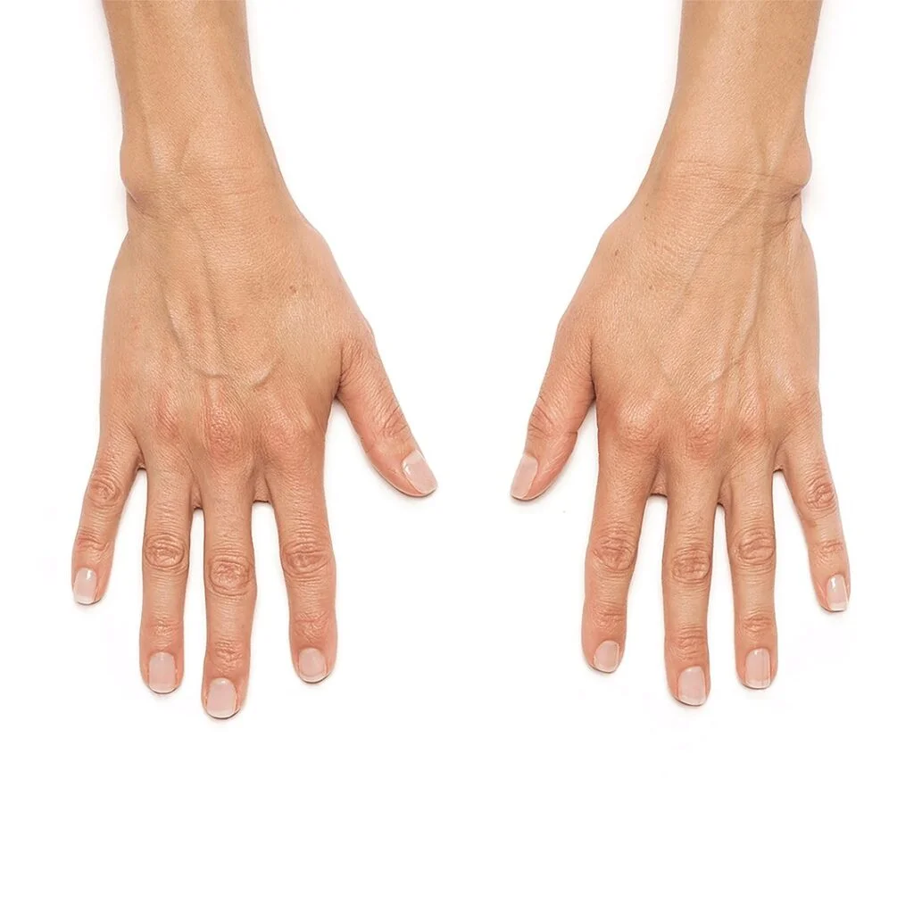 Hand Rejuvenation Before